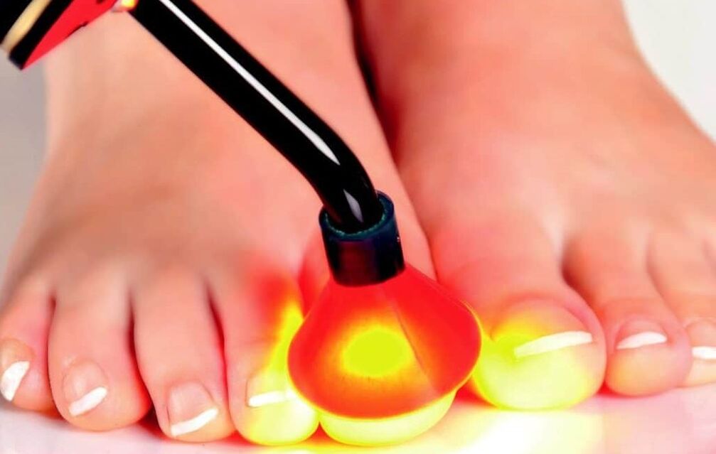 Laser treatment of nail plates
