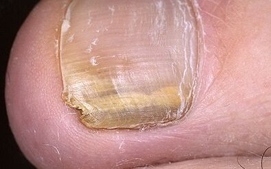 Fungus on the thumb