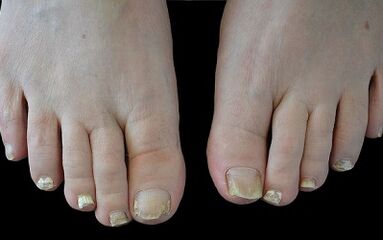 How to get rid of fungi on your fingers