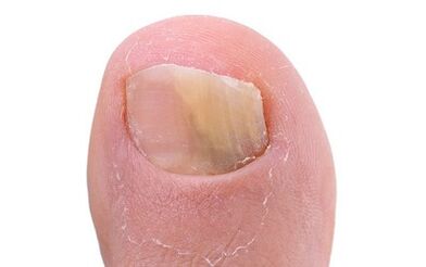 Symptoms of fungi on the thumb of the leg