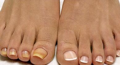 Fleet fungi treatment