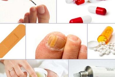 How to treat fungi on nails