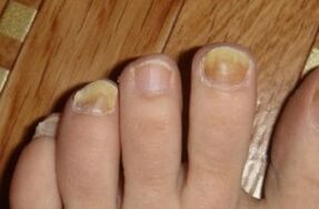 Yellowing of nails due to fungus