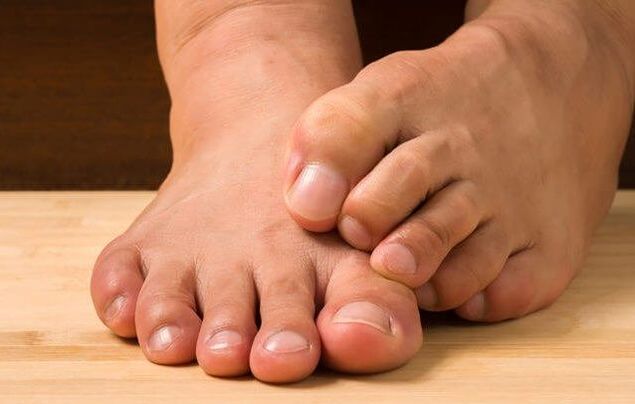 Foot fungus and how to treat it