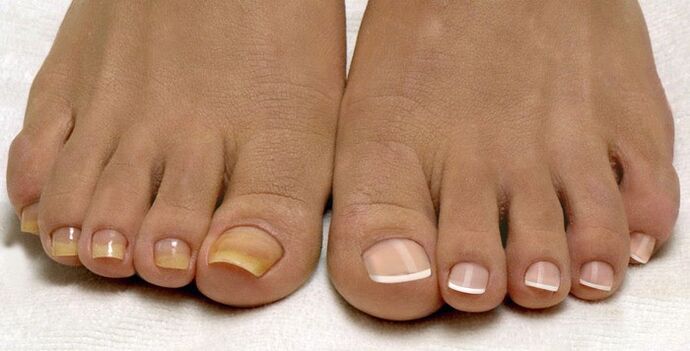 Onychomycosis grows on one foot