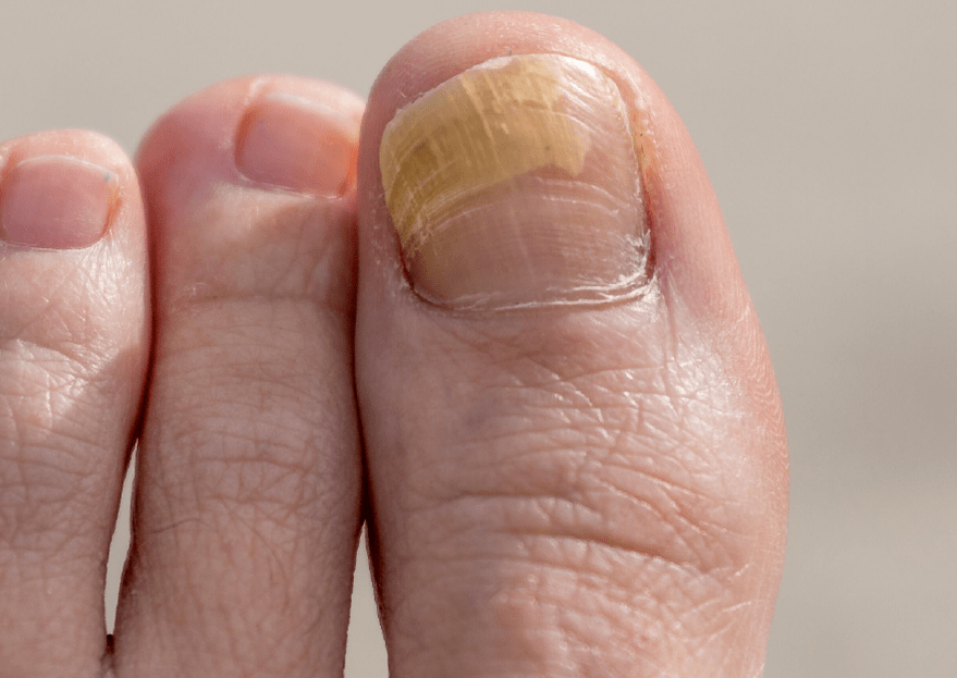 Fungus on big toenail
