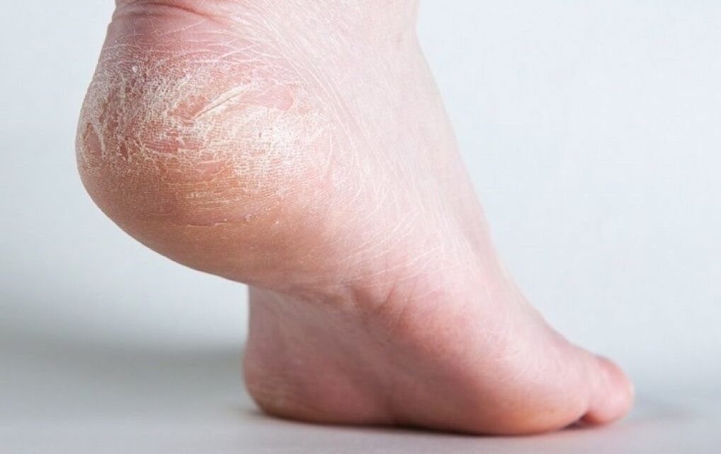 fungus on foot skin